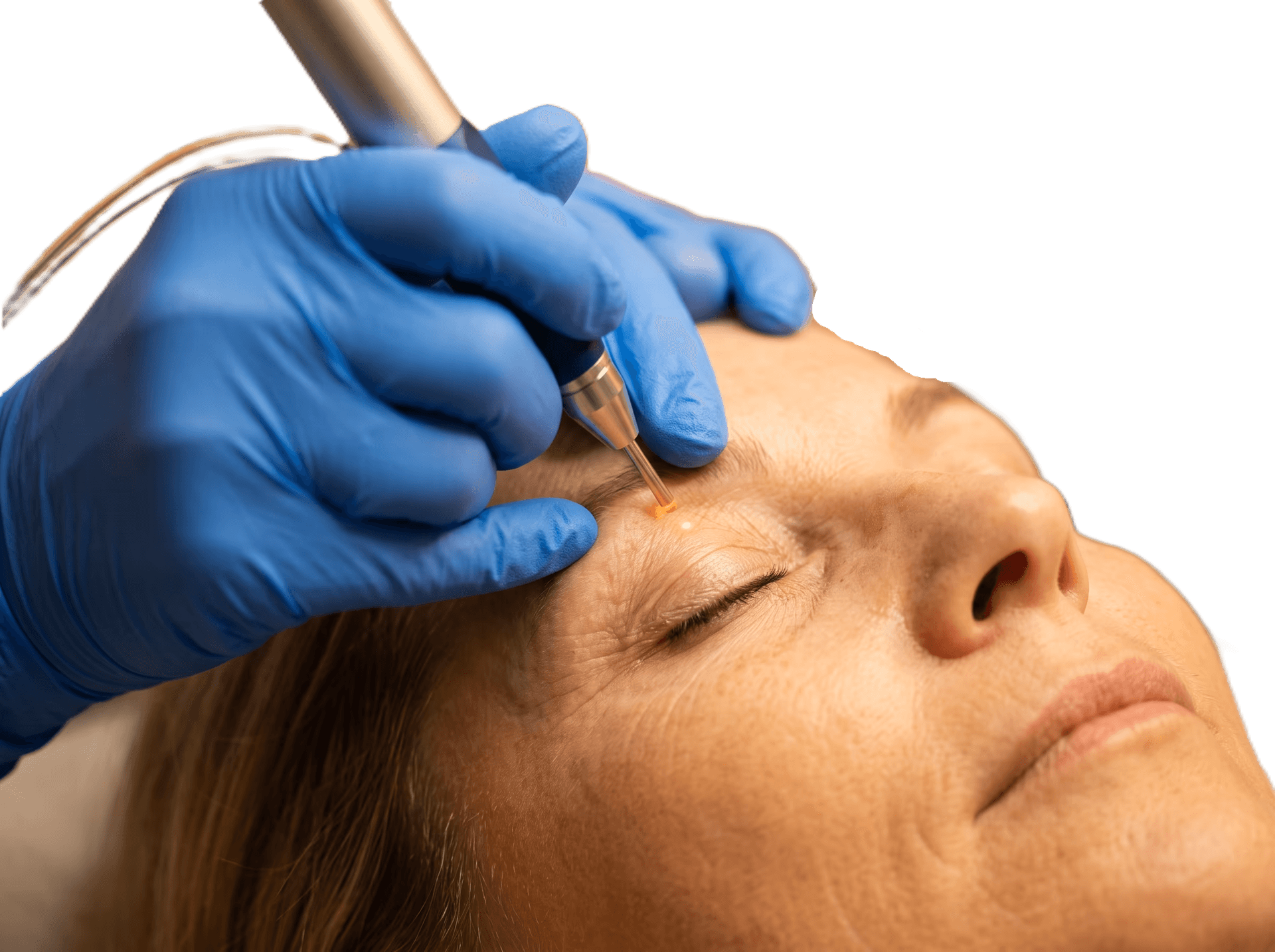 Blepharoplastik ohne Operation