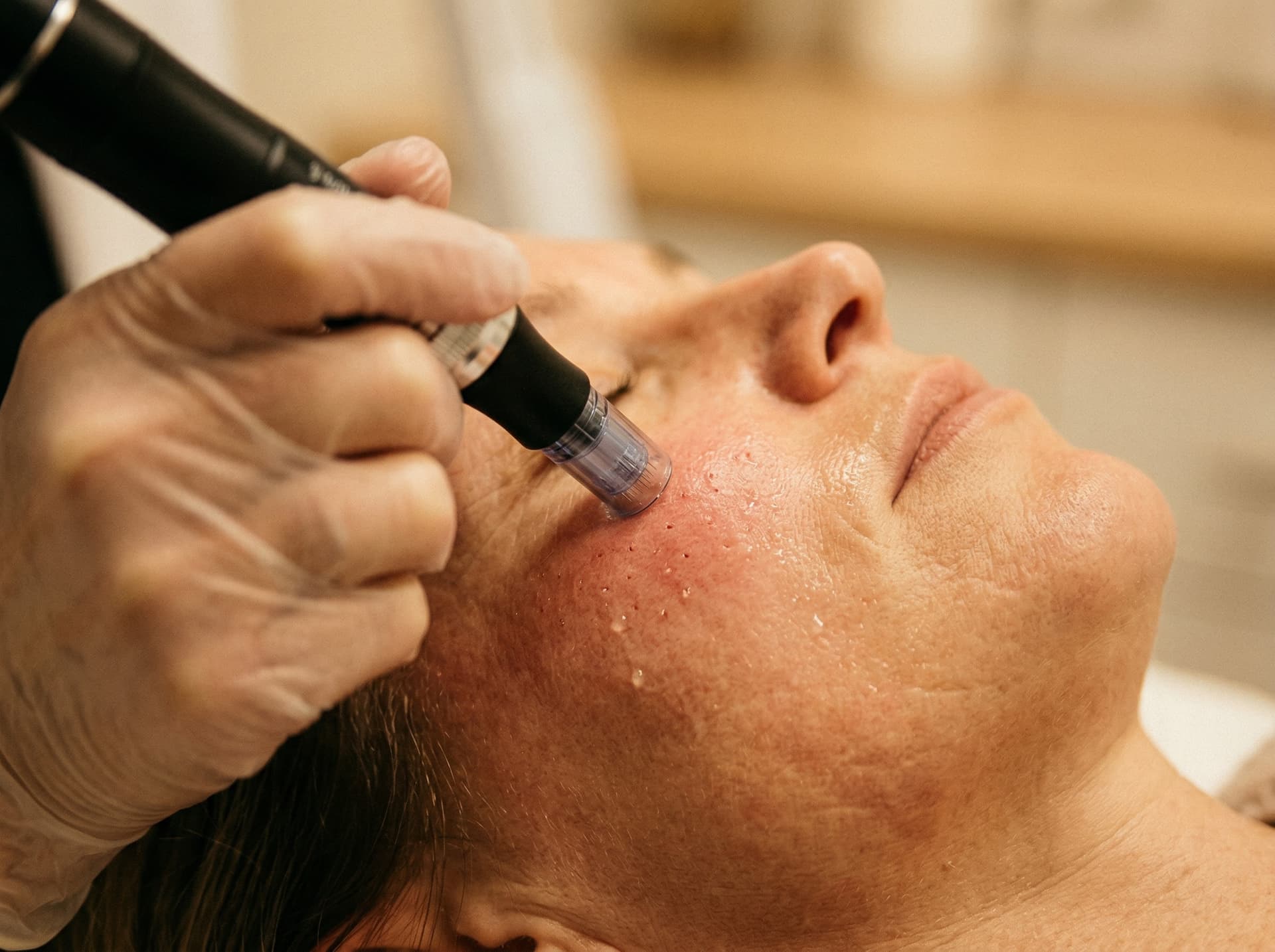 PRP Visage – Medical Needling