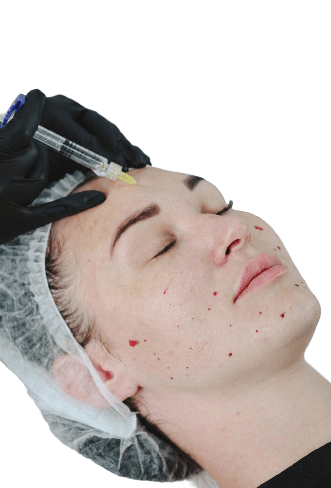 PRP Visage – Medical Needling